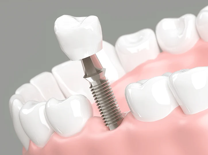 インプラント治療