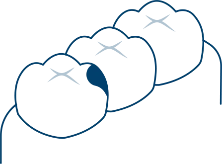 むし歯ができた