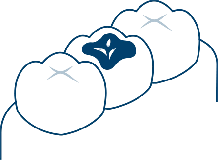 銀歯が気になる