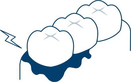 歯茎が腫れる・血が出る