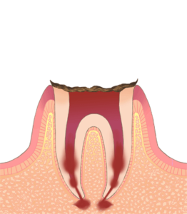 歯冠部の崩壊