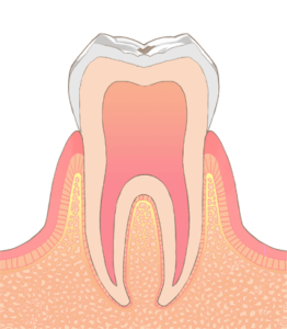 初期う蝕
