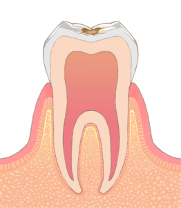 エナメル質の虫歯