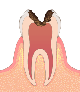 歯髄に到達